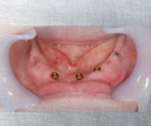 Image of persons gums with metal implants | Featured Image for Pearl Denture Studio | Denture Clinic Home Page