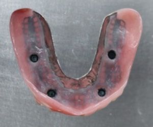 Image of implant retained dentures on metal table