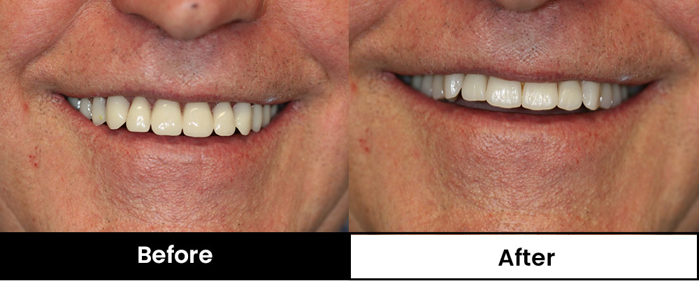 Image of patient with more natural looking dentures (before and after)