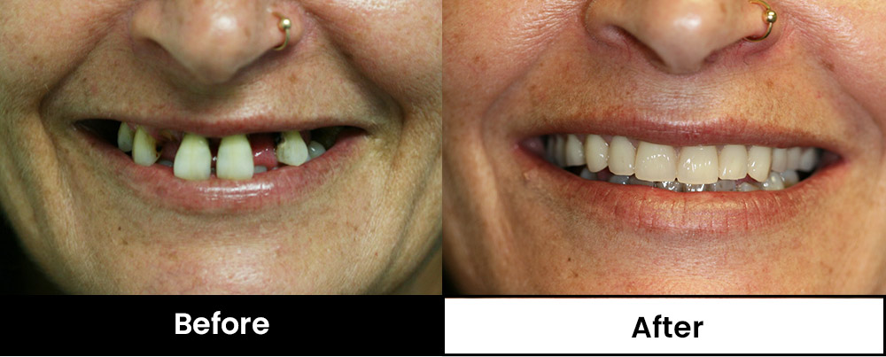 Image of patient with new partial dentures (Before and after)