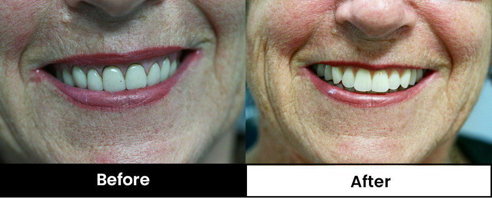 Before and after image of patient replacing old dentures