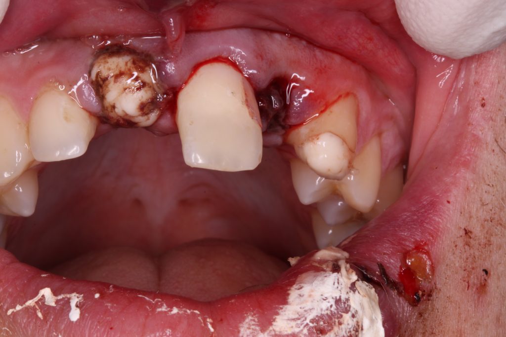 Image of damaged mouth and missing teeth with white blob on lip