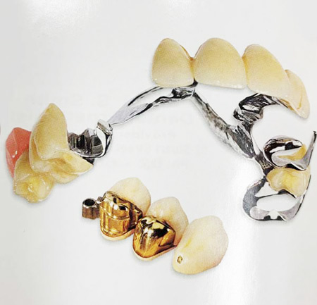 Image of partial dentures with metal clasps