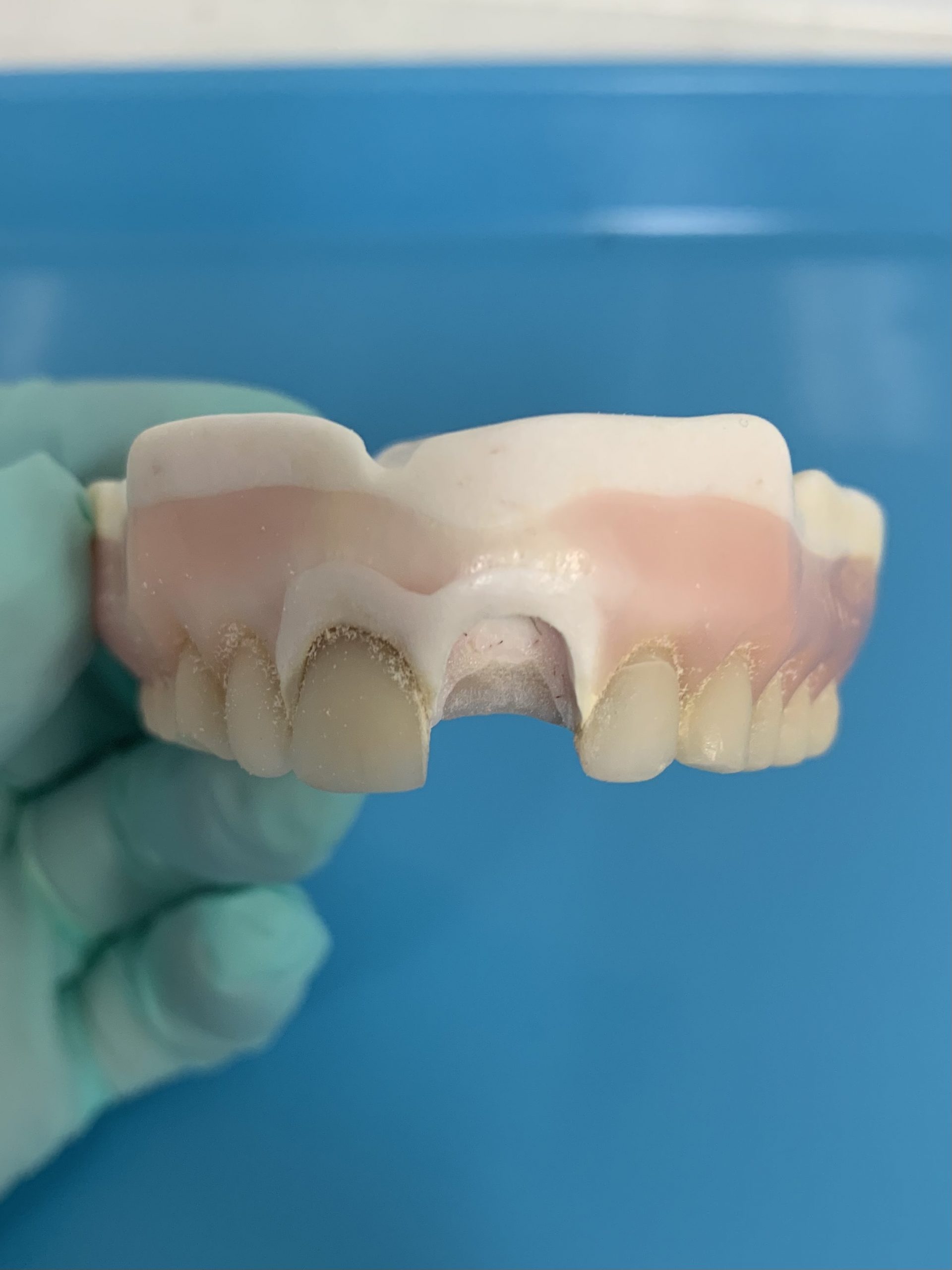 Original Image of Dentures for a patient | | Featured image for How Often Do You Need to Replace Dentures?