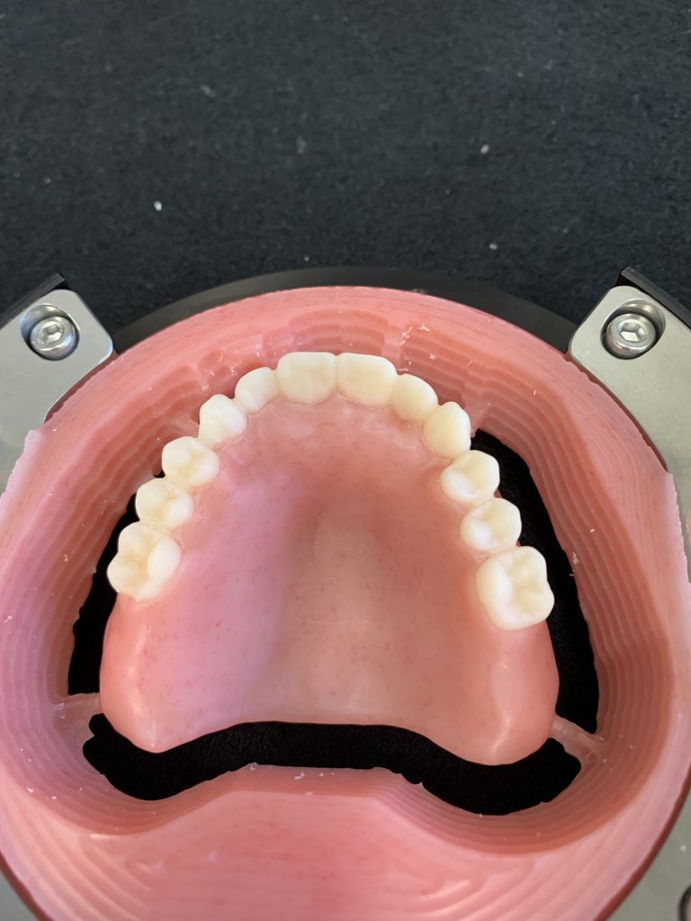 Original image of digital dentures for a client | Featured image for the different types of dentures blog