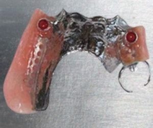Image of partial implant retained denture on metal table.